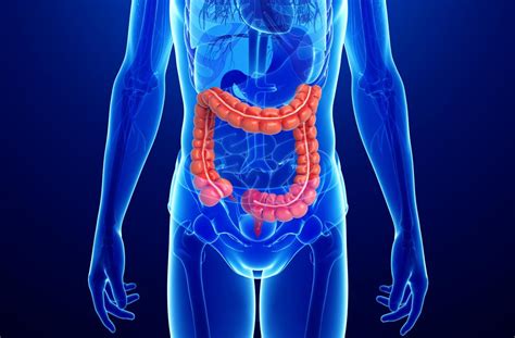 Crohns Disease Versus Ulcerative Colitis What Is The Difference