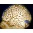 Cerebral Convexity Landmarks  Neuroanatomy The Neurosurgical Atlas