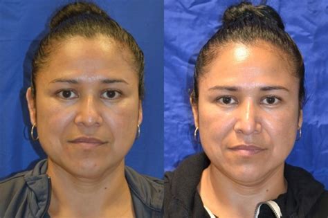Nose Surgery Before And After Photos Patient 195 San Francisco Ca