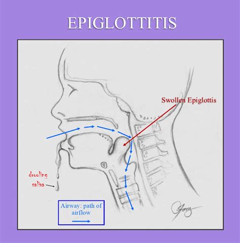 Epiglottis Another Reason For Vaccinating Your Child