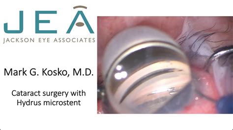 Cataract Surgery With Hydrus Microstent Kosko Youtube