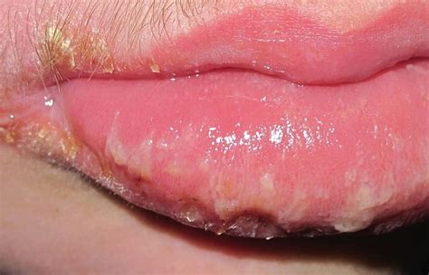 Lip Swelling As Initial Manifestation Of Crohns Disease Archives Of