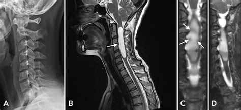 Cervical Mri Coronal A And Axial B Plane Showing A My XXX Hot Girl