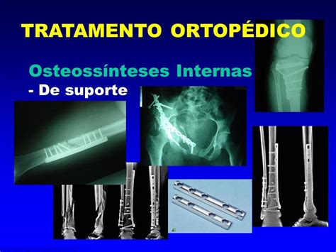 Osteossíntese Com Placa E Parafuso
