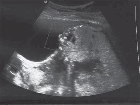 Learn more about the signs, causes and management of placenta accreta here. Placenta accreta, ultrasound examination, case 3 ...