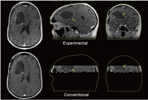 High Resolution Whole Brain Dynamic Contrast Enhanced Mri Using