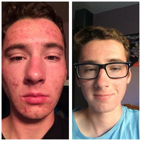 Selfiebanda Accutane Before And After So Happy To Have Clear Skin