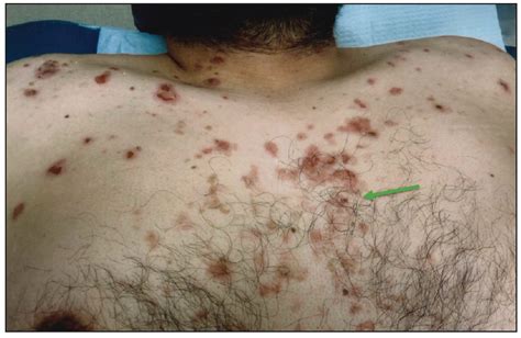 A Case Of Pemphigus Foliaceus Practical Dermatology