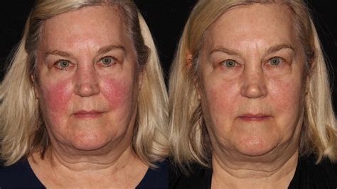 Bbl Photofacial Before And After Pictures Case 5 Chico Yuba City