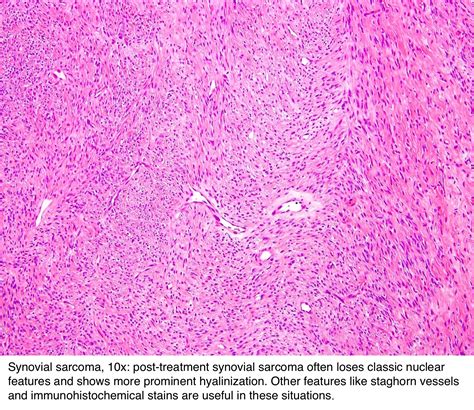 Pathology Outlines Synovial Sarcoma
