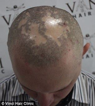 Should you want a full fake hair tattoo, the cost typically starts around us$2,000 and can go as high as us$4,000. Bald men turn to hair tattoos to creates the illusion of ...