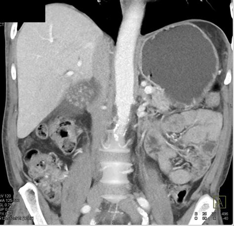 Distended Gallbladder Liver Case Studies Ctisus Ct Scanning