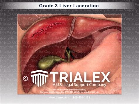 Liver Laceration Grades