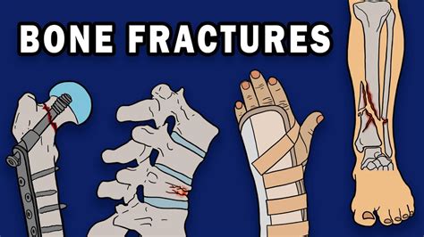 Bone Fractures Youtube