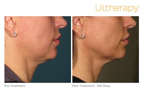 Ultherapy Non Invasive Skin Tightening Surgery Chevy Chase Md