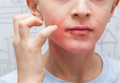 Psoriasis Face Stock Photos Pictures And Royalty Free Images Istock