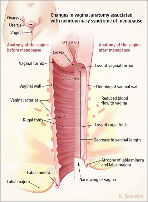 Vaginal And Urinary Symptoms Of Menopause Patient Information JAMA The JAMA Network