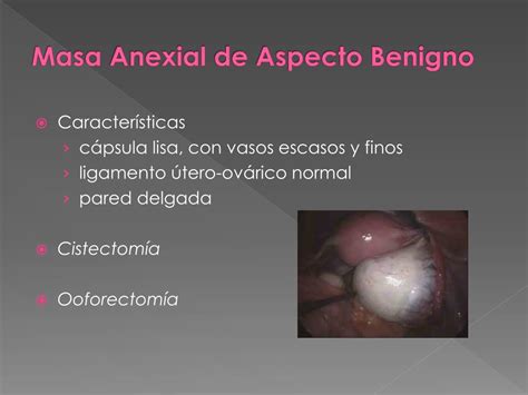 Ausencia De Massa Ou Coleções Anexiais