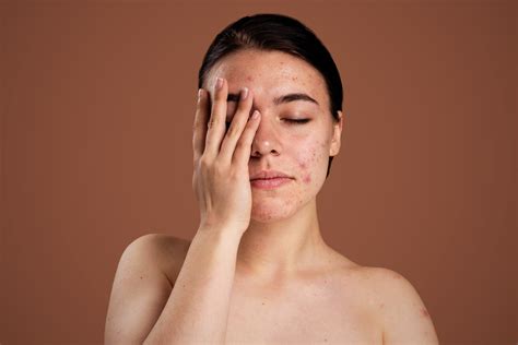 Can Ayurveda Cure Skin Problems