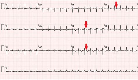 Lead Ecg Sinus Tachycardia