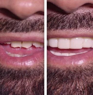 Floss between your teeth as you normally would without braces. Veneers Cost |Clip on|Press On Veneers Kit at Home Do It Yourself|Snap On Smile | Snap on smile