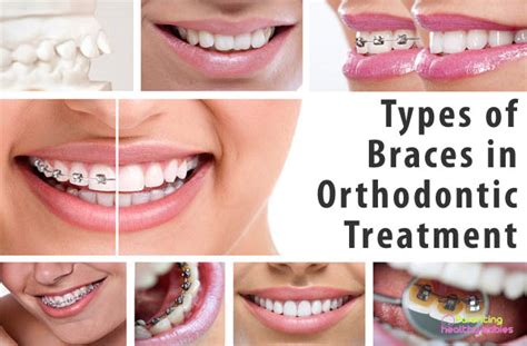 7 most common types of braces used in orthodontic treatment