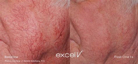 Cutera Excel V — Dermatologist The Dermatology Center