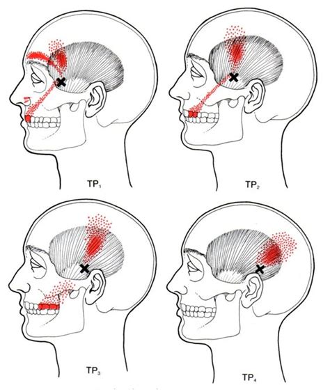 Temporalis The Trigger Point And Referred Pain Guide Triggers