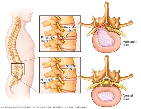 Pinched Nerve Symptoms And Causes Mayo Clinic