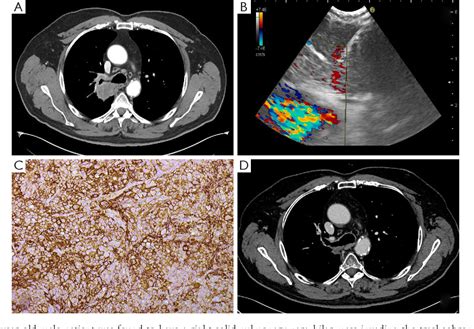Figure 1 From The Role Of Ebus Tbna In Lung Cancer Restaging And