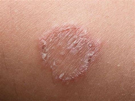 Ringworm Pictures What Does Ringworm Look Like