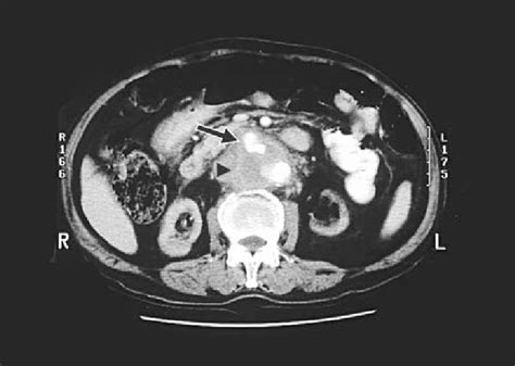 Preoperative Abdominal Computed Tomography Ct Scan With Contrast