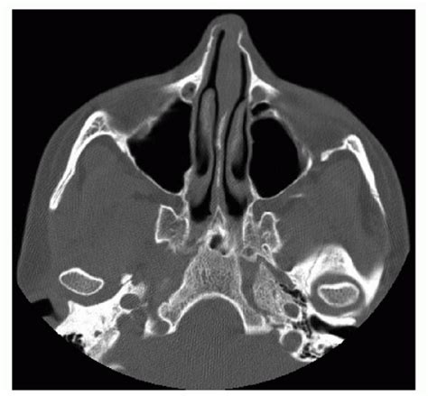 Nasal Bone Fracture Radiology Ct Ppt Radiology Of The Ear
