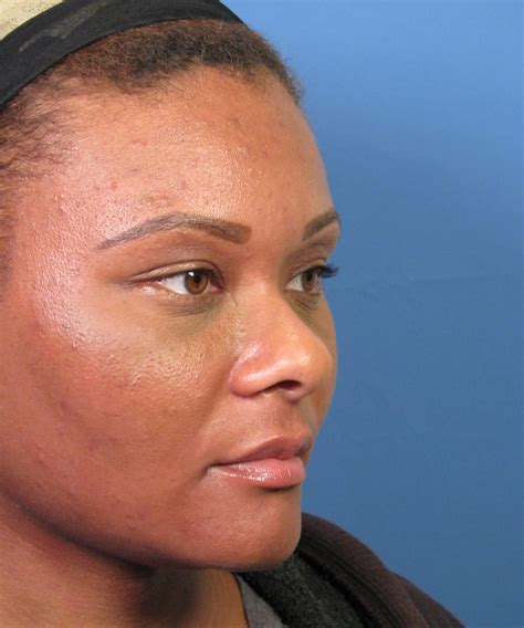 Can a rhinoplasty be done on an african face? African-American Nose Job