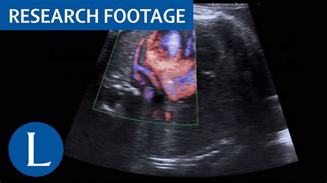 Standard Fetal Echocardiography In A Fetus With Abnormal Pulmonary