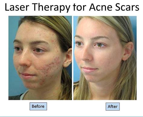 Fast Laser Treatment For Acne Scars Clear Clinic