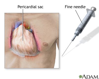 • cardiac pain (ischaemic heart disease, myocarditis, pericarditis) • oesophageal pain (peptic oesophagitis typical signs of invasive infection. Pericarditis - after heart attack | UF Health, University ...