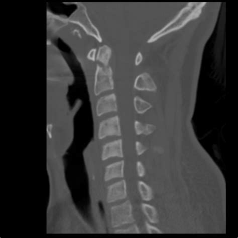 C Spine Injuries Ct Interpretation Core Em