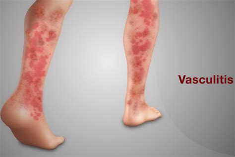 Vasculitis IAS GYAN