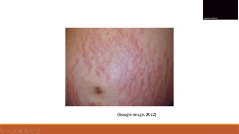 Pruritic Urticarial Papules And Plaques Of Pregnancy Youtube