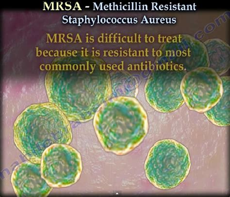 Methicillin Resistant Staphylococcus Aureus MRSA