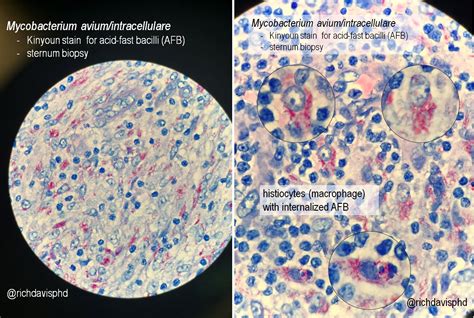 Mycobacterium Avium Intracellulare On Microscopy Sternum Grepmed