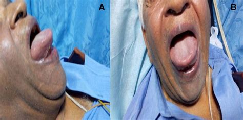 Caution In Diagnosing Angioedema As Anaphylaxis Bmj Case Reports