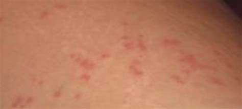 Red Bumps On Skin Dorothee Padraig South West Skin Health Care