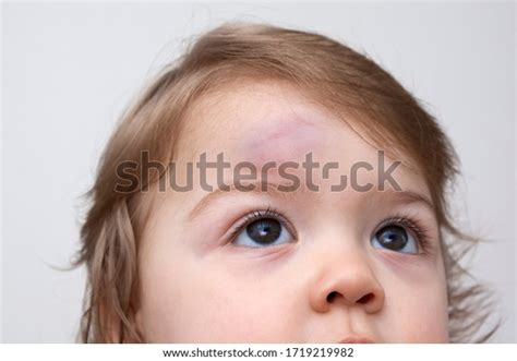 Large Bump On Childs Forehead Baby Stock Photo 1719219982 Shutterstock
