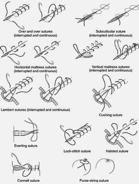 Types Of Suturing Stitches Medical Surgical Suture Medical Knowledge
