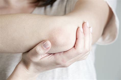Winterizing Dry Itchy Skin On The Elbow Area Stock Photo Download