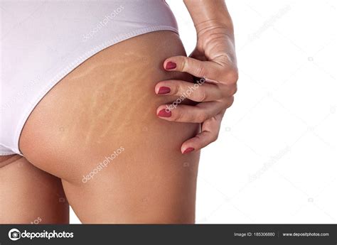 Woman Buttocks With Stretch Marks And Cellulite Stock Photo By