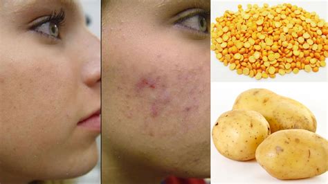 How To Get Rid Of Acne Scars Hyperpigmentation And Dark Spots In Just 7