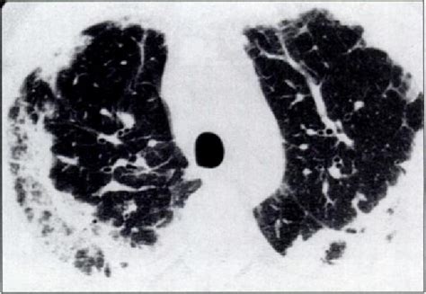 Figure 1 52 From Churg Strauss Syndrome The Spectrum Of Pulmonary Ct